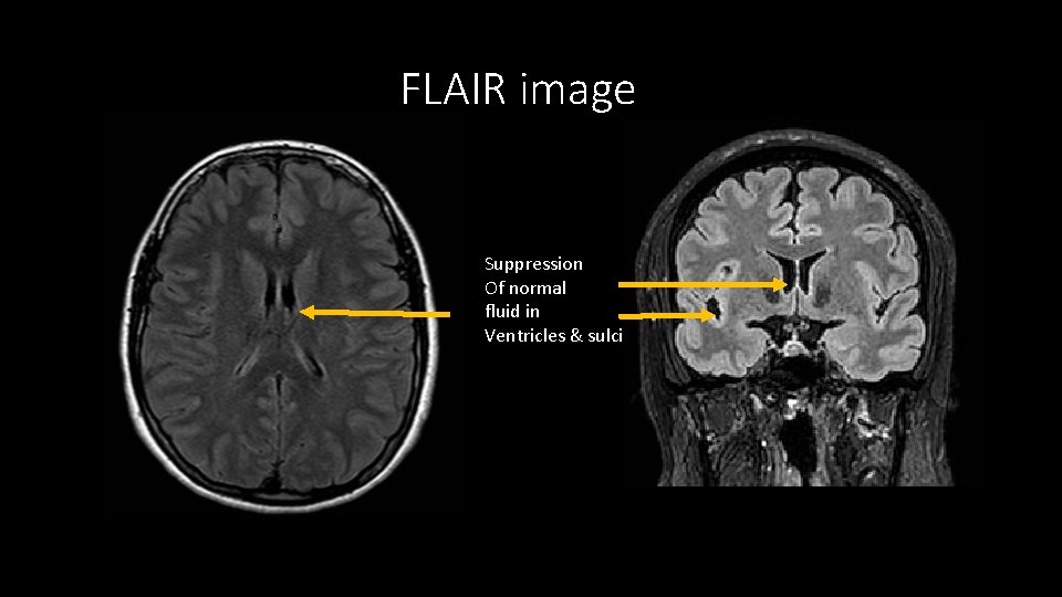 FLAIR image Suppression Of normal fluid in Ventricles & sulci 