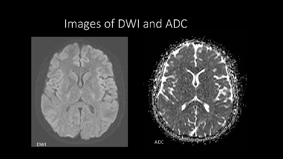 Images of DWI and ADC DWI ADC 