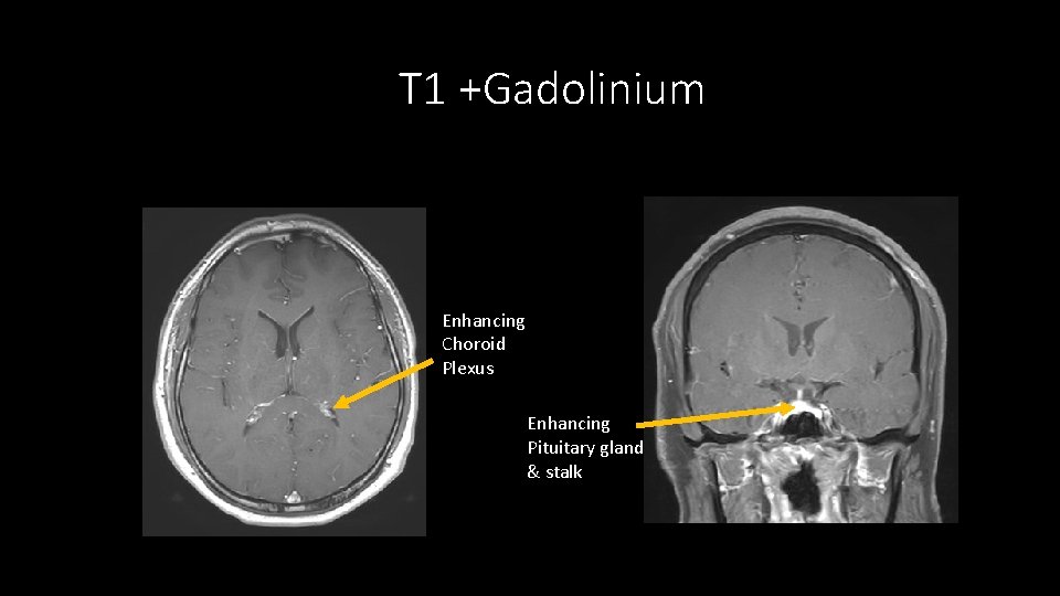 T 1 +Gadolinium Enhancing Choroid Plexus Enhancing Pituitary gland & stalk 