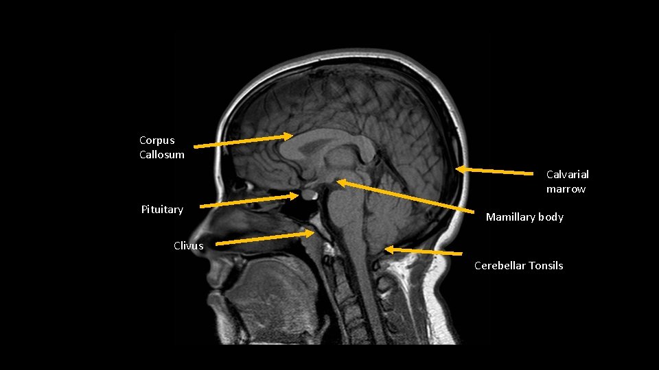 Corpus Callosum Calvarial marrow Pituitary Mamillary body Clivus Cerebellar Tonsils 