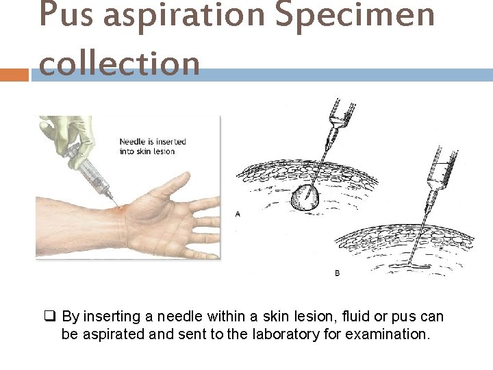 Pus aspiration Specimen collection q By inserting a needle within a skin lesion, fluid