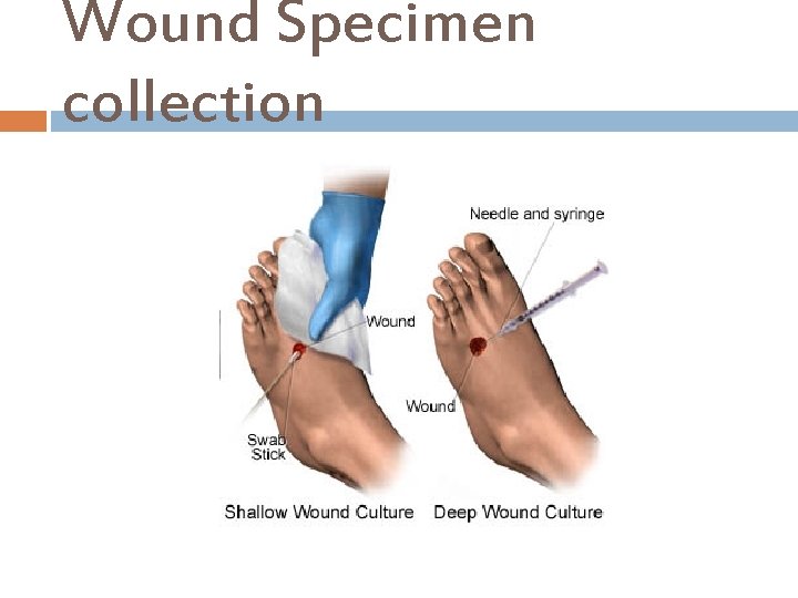 Wound Specimen collection 