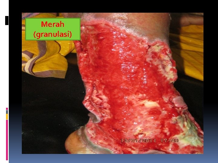 Merah (granulasi) 