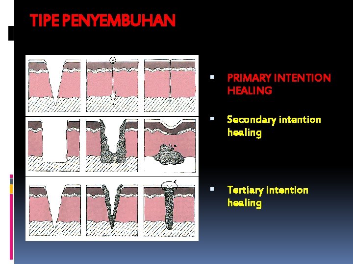 TIPE PENYEMBUHAN PRIMARY INTENTION HEALING Secondary intention healing Tertiary intention healing 