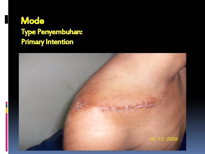 Mode Type Penyembuhan: Primary Intention 