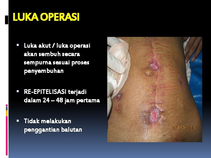 LUKA OPERASI Luka akut / luka operasi akan sembuh secara sempurna sesuai proses penyembuhan
