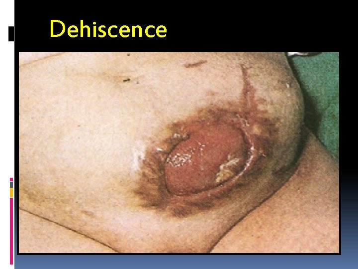 Dehiscence 