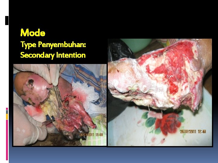 Mode Type Penyembuhan: Secondary Intention 