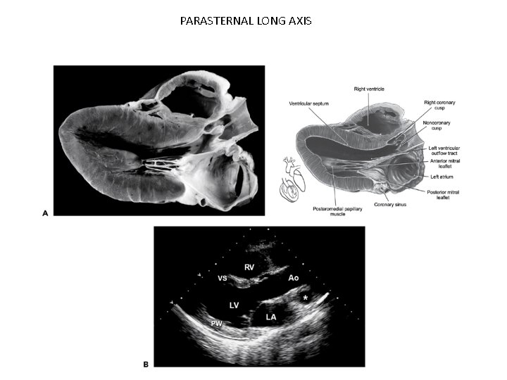 PARASTERNAL LONG AXIS 