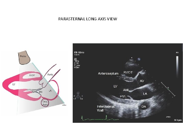 PARASTERNAL LONG AXIS VIEW 