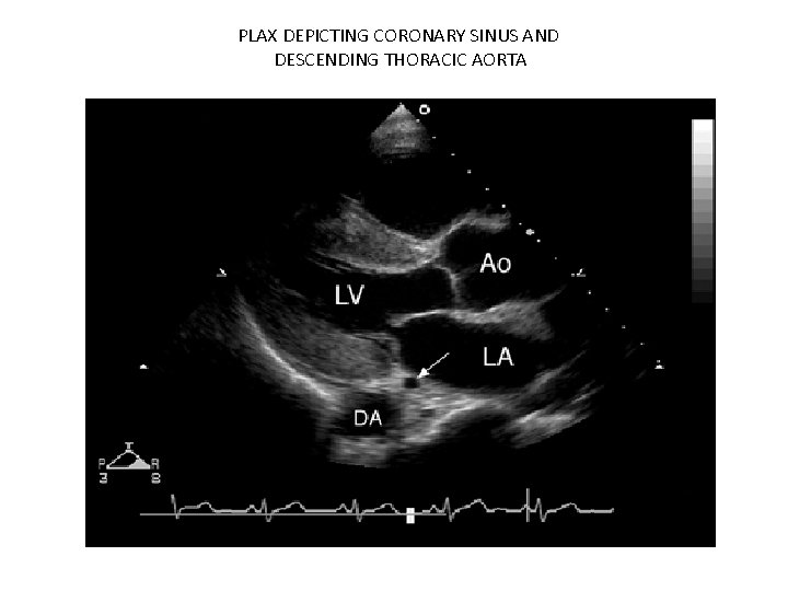 PLAX DEPICTING CORONARY SINUS AND DESCENDING THORACIC AORTA 