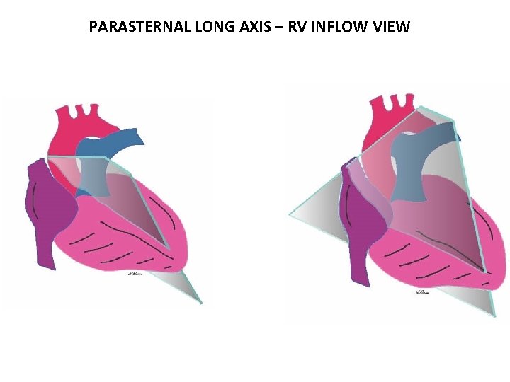 PARASTERNAL LONG AXIS – RV INFLOW VIEW 