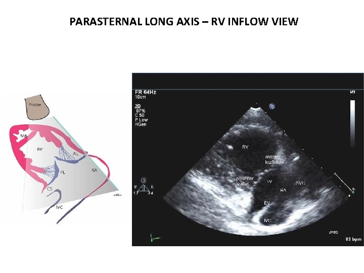 PARASTERNAL LONG AXIS – RV INFLOW VIEW 