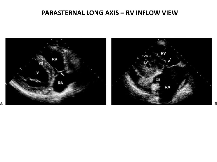 PARASTERNAL LONG AXIS – RV INFLOW VIEW 