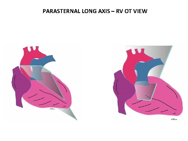 PARASTERNAL LONG AXIS – RV OT VIEW 