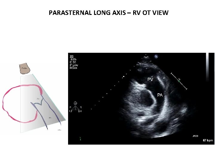 PARASTERNAL LONG AXIS – RV OT VIEW 
