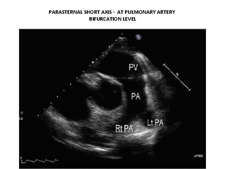 PARASTERNAL SHORT AXIS - AT PULMONARY ARTERY BIFURCATION LEVEL 