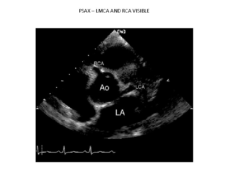 PSAX – LMCA AND RCA VISIBLE 