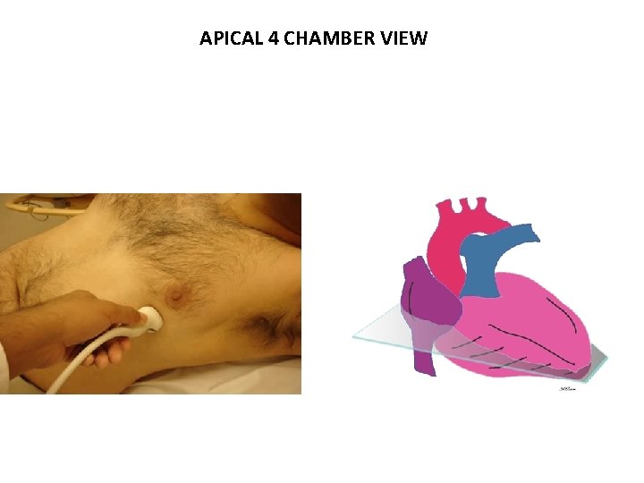 APICAL 4 CHAMBER VIEW 