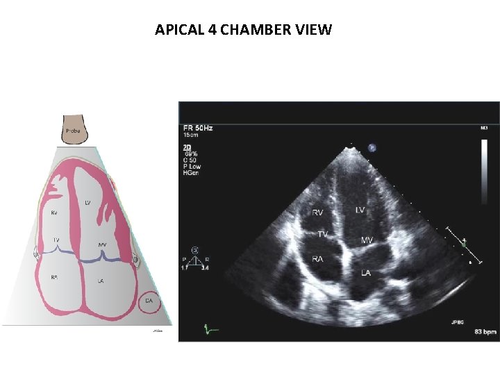 APICAL 4 CHAMBER VIEW 