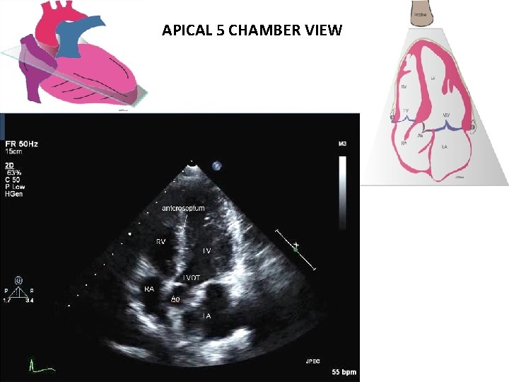 APICAL 5 CHAMBER VIEW 