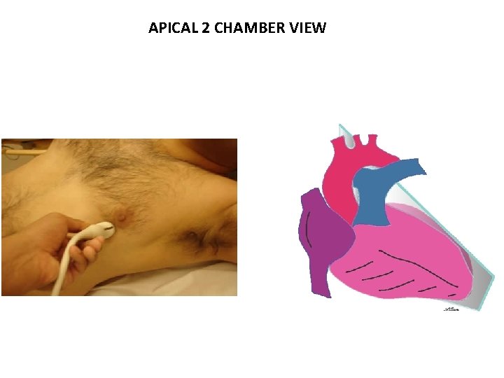 APICAL 2 CHAMBER VIEW 