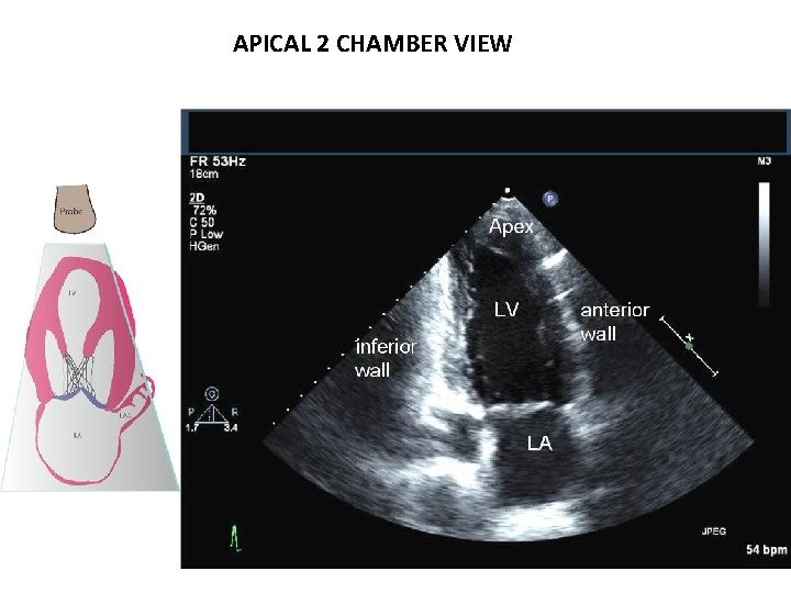 APICAL 2 CHAMBER VIEW 