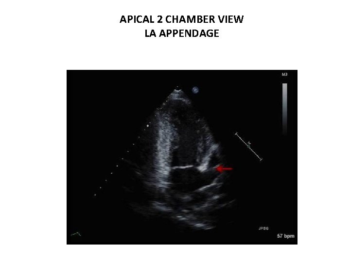 APICAL 2 CHAMBER VIEW LA APPENDAGE 