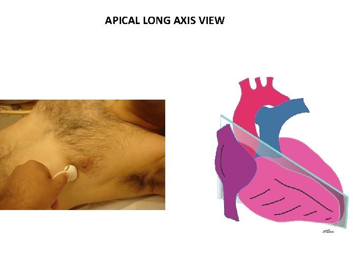 APICAL LONG AXIS VIEW 