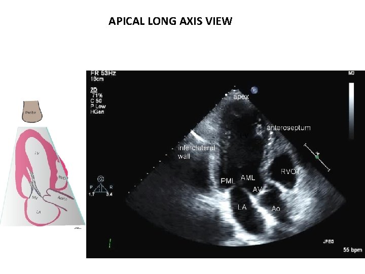 APICAL LONG AXIS VIEW 