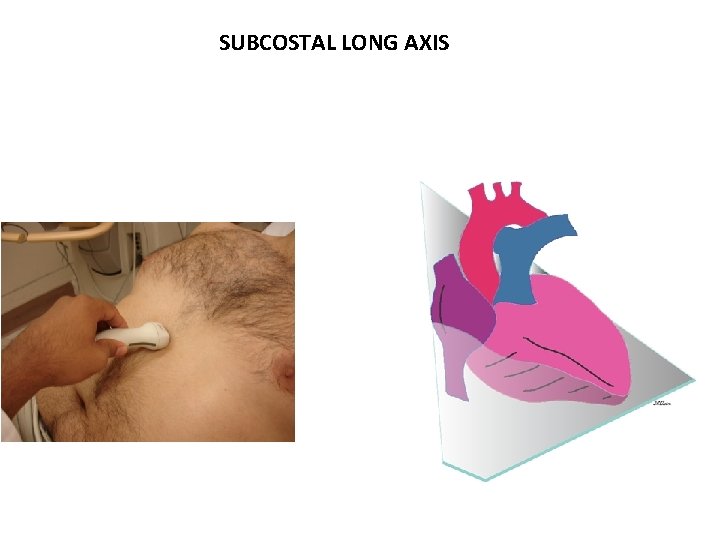 SUBCOSTAL LONG AXIS 