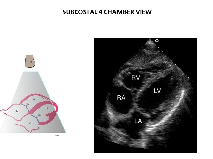 SUBCOSTAL 4 CHAMBER VIEW 
