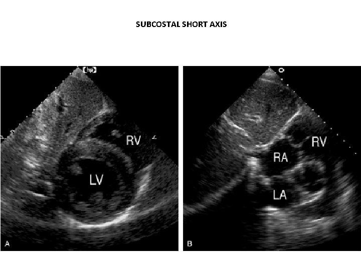 SUBCOSTAL SHORT AXIS 