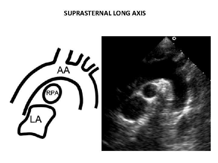 SUPRASTERNAL LONG AXIS 