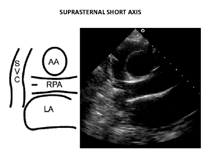 SUPRASTERNAL SHORT AXIS 