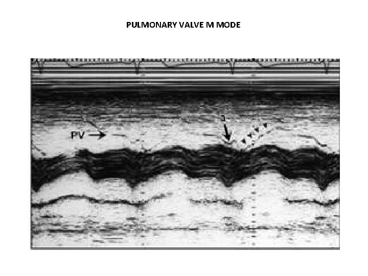 PULMONARY VALVE M MODE 