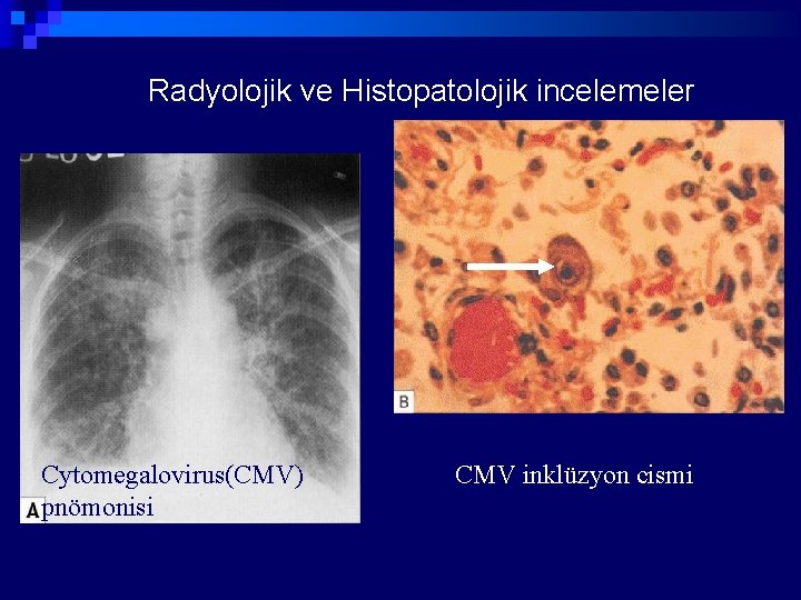 Radyolojik ve Histopatolojik incelemeler Cytomegalovirus(CMV) pnömonisi CMV inklüzyon cismi 