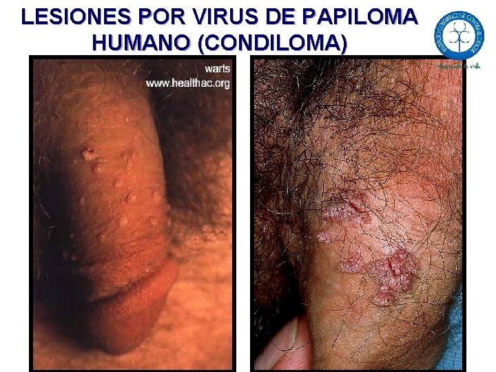 LESIONES POR VIRUS DE PAPILOMA HUMANO (CONDILOMA) 