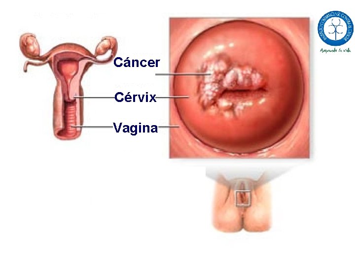 Cáncer Cérvix Vagina 