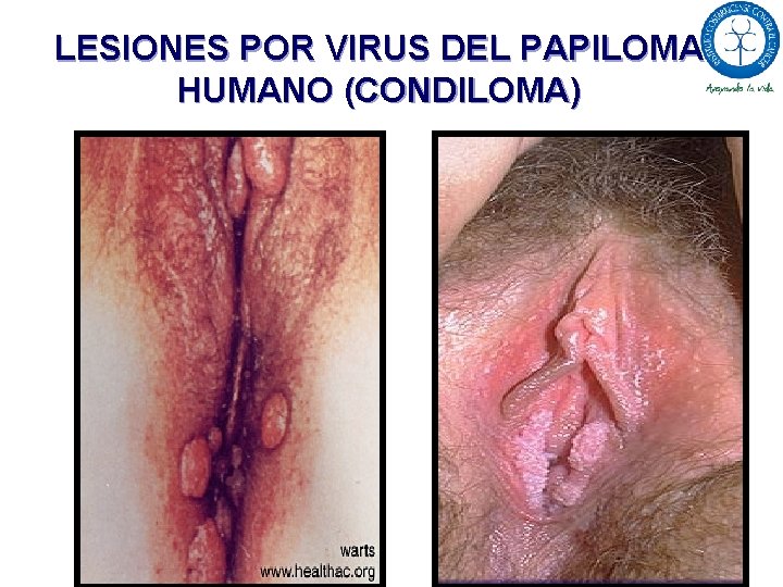 LESIONES POR VIRUS DEL PAPILOMA HUMANO (CONDILOMA) 