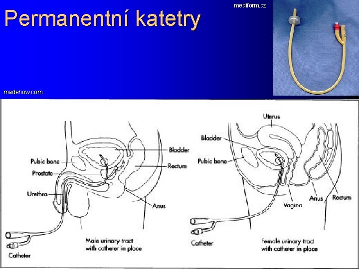 Permanentní katetry madehow. com mediform. cz 