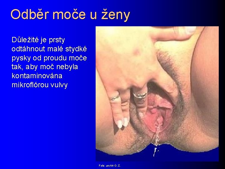 Odběr moče u ženy Důležité je prsty odtáhnout malé stydké pysky od proudu moče