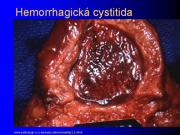 Hemorrhagická cystitida www. pathology. vcu. edu/education/renal/lab 2. p. html. 