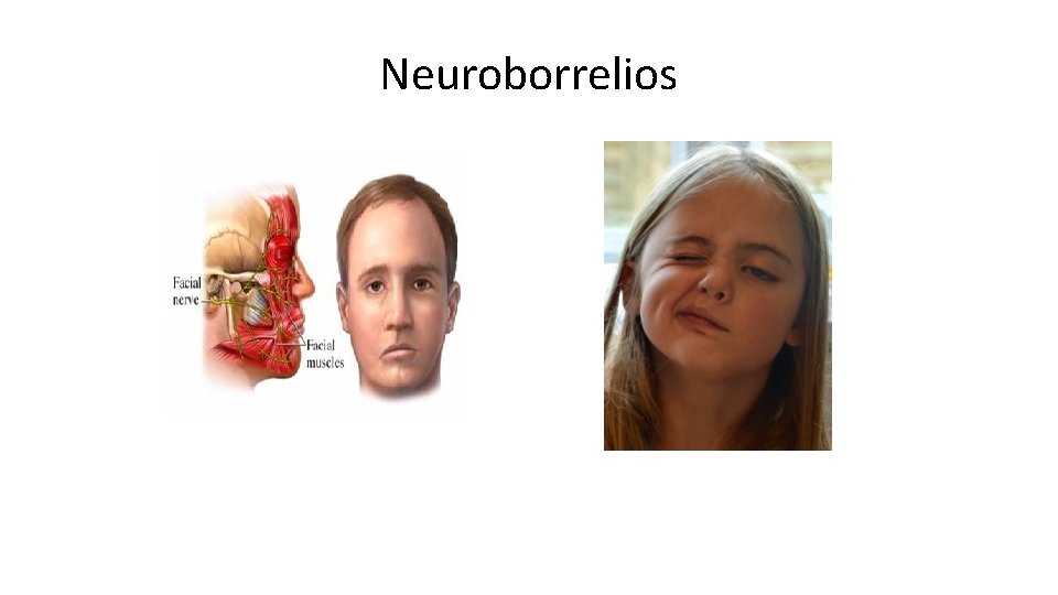 Neuroborrelios 