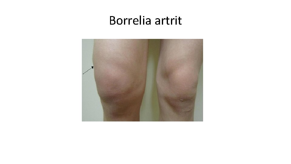 Borrelia artrit 
