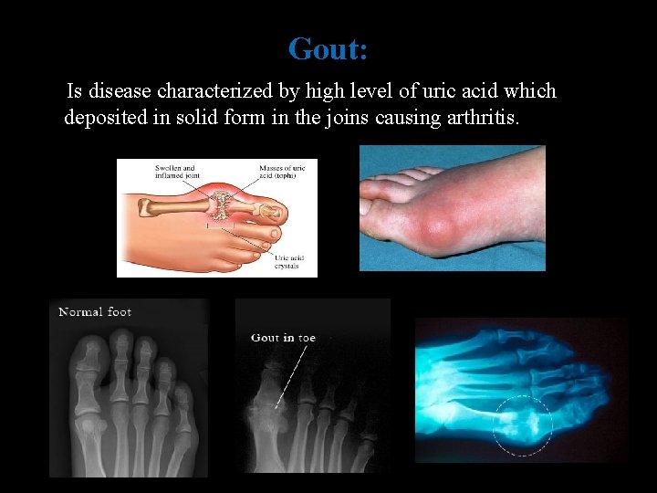 Gout: Is disease characterized by high level of uric acid which deposited in solid