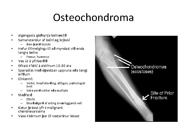 Osteochondroma • • algengasta góðkynja beinæxlið Samanstendur af beini og brjóski – • Hefur