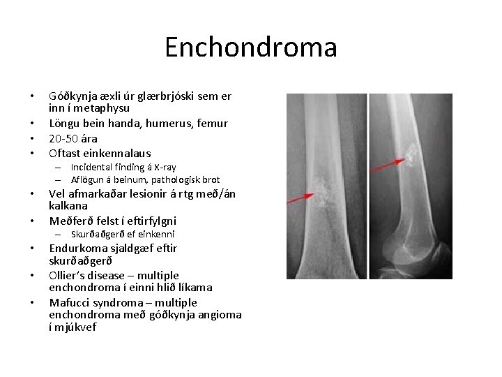 Enchondroma • • Góðkynja æxli úr glærbrjóski sem er inn í metaphysu Löngu bein