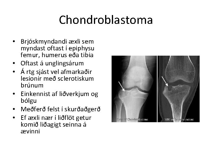 Chondroblastoma • Brjóskmyndandi æxli sem myndast oftast í epiphysu femur, humerus eða tibia •