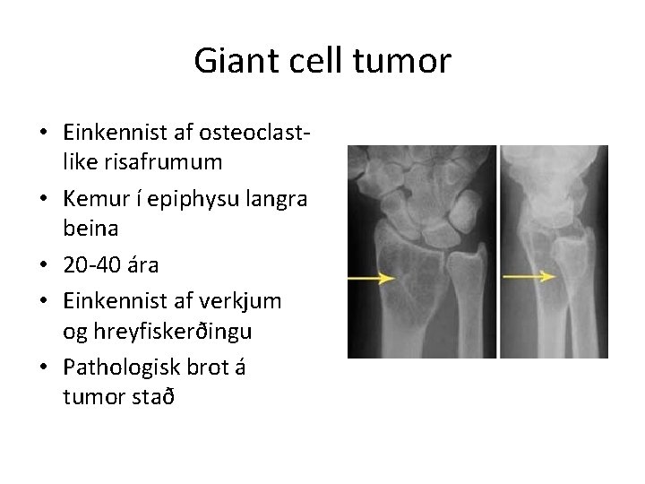 Giant cell tumor • Einkennist af osteoclastlike risafrumum • Kemur í epiphysu langra beina